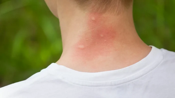 Не «крошечная» опасность: укус этих насекомых может привести к серьезной аллергии