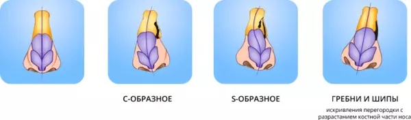 искривление носовой перегородки