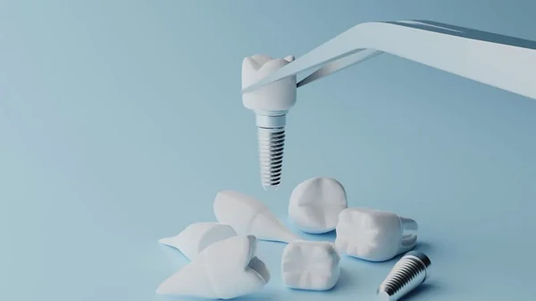 Імплантація зубів у Львові