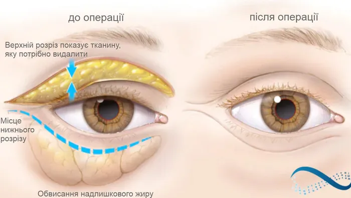 верхня блефаропластика