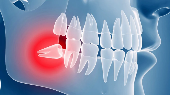 видалення зубів