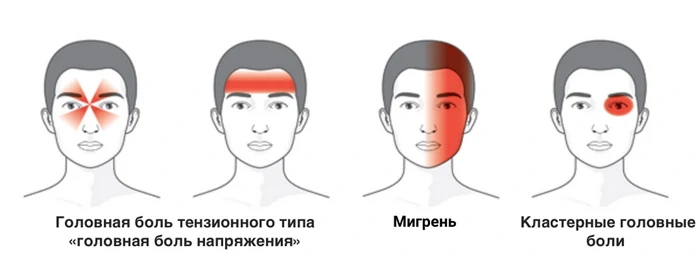 Как отличить головную боль напряжения от мигрени