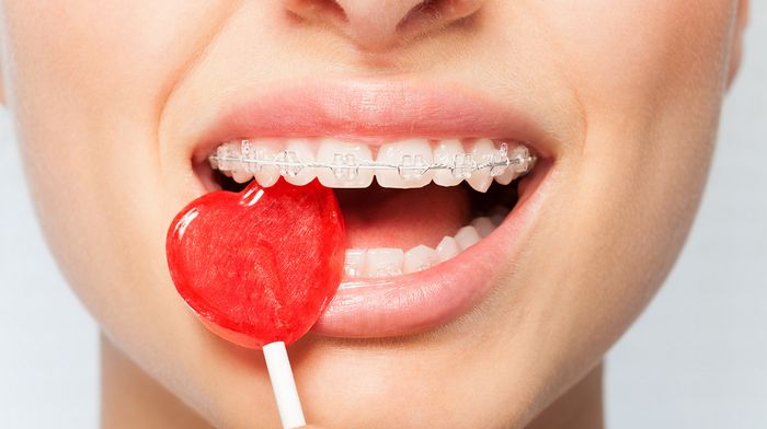 Керамические брекеты: высокая эффективность без потери эстетики