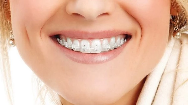 Керамические брекеты: высокая эффективность без потери эстетики