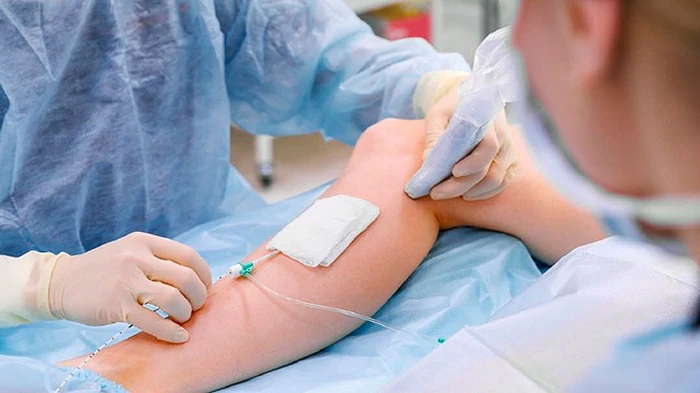 EVLA (ендовенозна лазерна абляція)