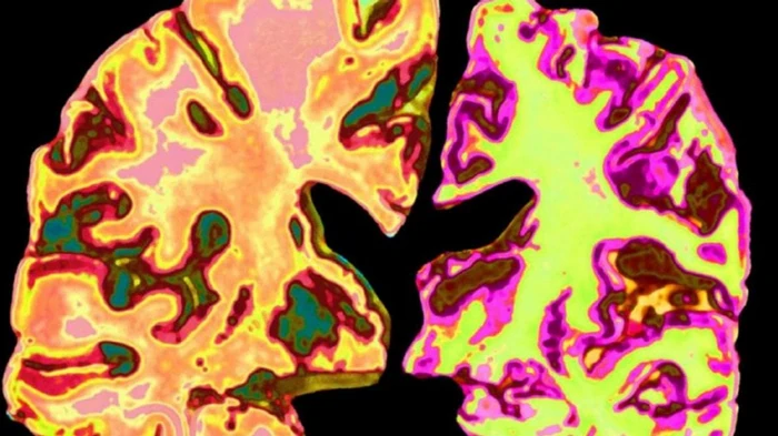 Болезнь Альцгеймера: ученые выяснили, какой химический элемент позволит ее победить