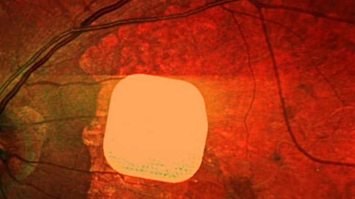 Британские врачи частично восстановили зрение пациентам с помощью микрочипа